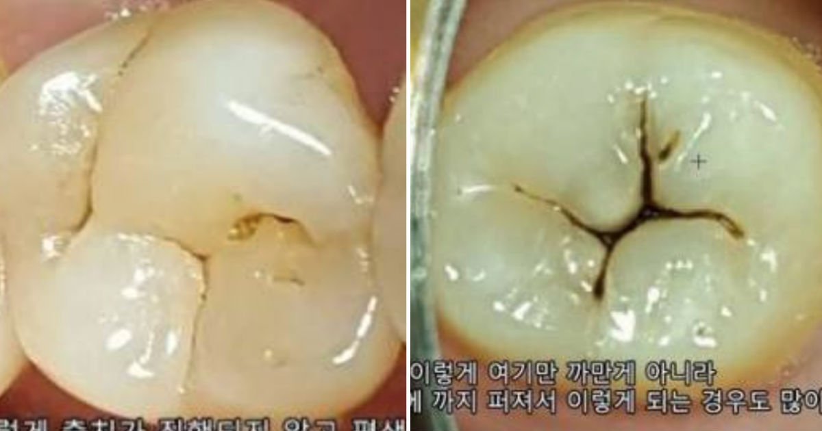 teeth.jpg?resize=1200,630 - 충격적인 '치아 건강'의 비밀.jpg