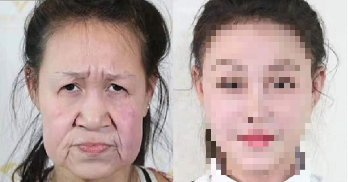 2 152.jpg?resize=412,232 - 「このおばあさんの年齢は、15歳です」…これまでシワシワの顔で生きてきた少女の整形手術ビフォー＆アフター
