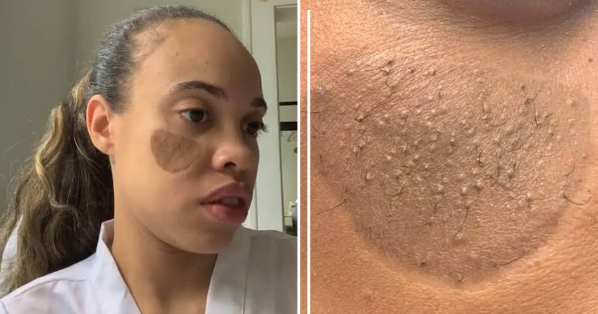 2 22.png?resize=412,275 - A Woman Undergoes The Growth of Literal Pubic Hair to Repair Dog Bite