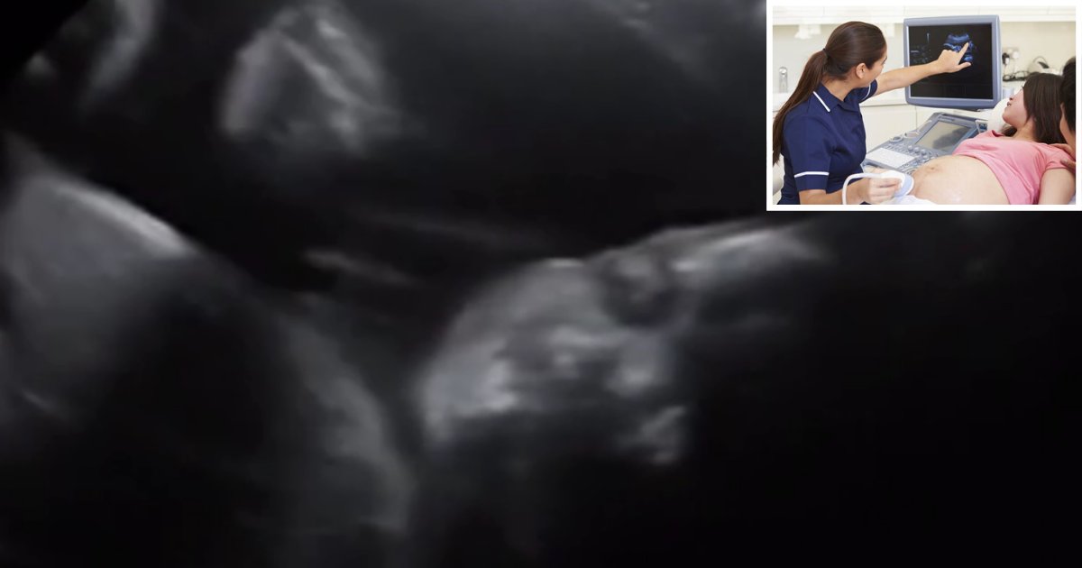 3 39.png?resize=412,275 - Unborn Infant Seems to Wave During Ultrasound Scan