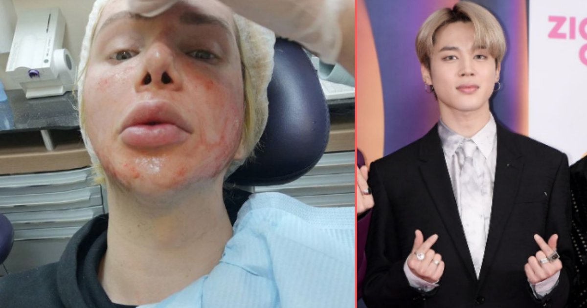 6 45.png?resize=1200,630 - A Fan Obsessed With BTS Spent €117K On Surgery to Look Like His Favorite Member