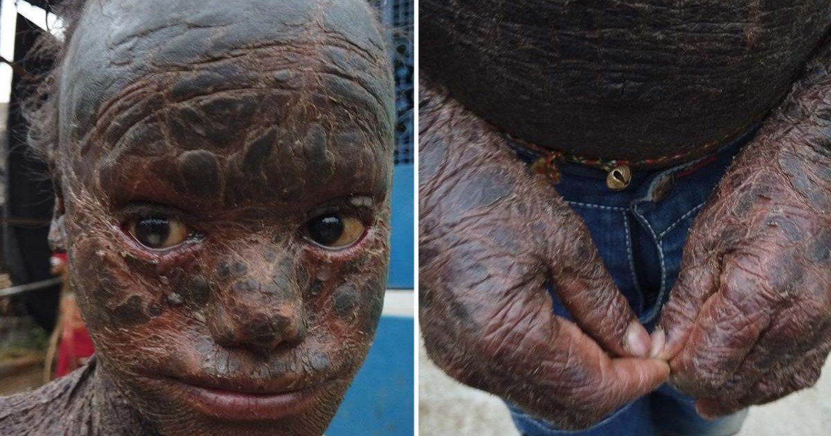 9 39.jpg?resize=412,275 - Rare Skin Condition Led 10-Year-Old Boy To Have His Skin Covered In Thick Scales