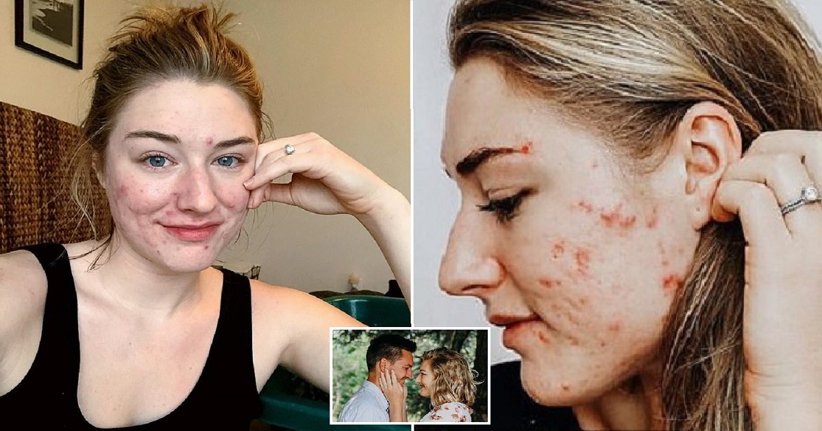 a4.jpg?resize=412,232 - 25-Year-Old Woman Felt Unworthy Of Love Due To Her Severe Acne