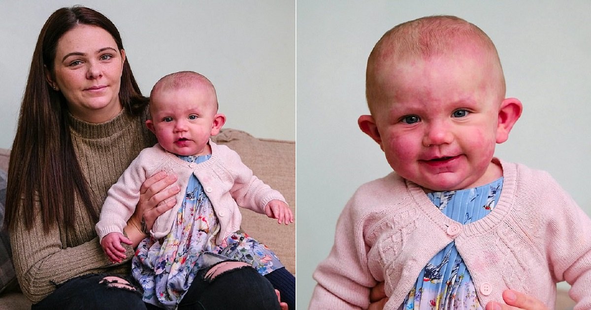 b3 2.jpg?resize=412,275 - A Mom Hid Her Daughter Born With Purple Birthmarks For Six Weeks Amid Fears Of Rude Comments From People