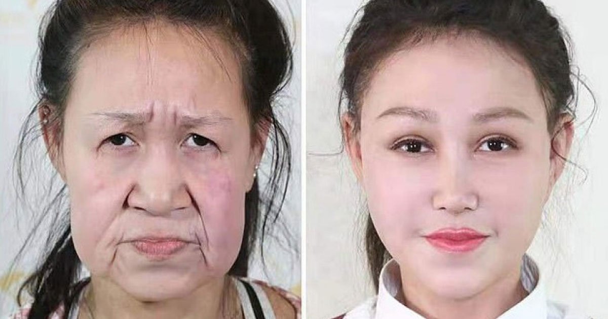 girl looked decades older surgery.jpg?resize=1200,630 - 15-Year-Old - Who Was Bullied For Looking Decades Older - Got A New Appearance After Strangers Raised £20,000