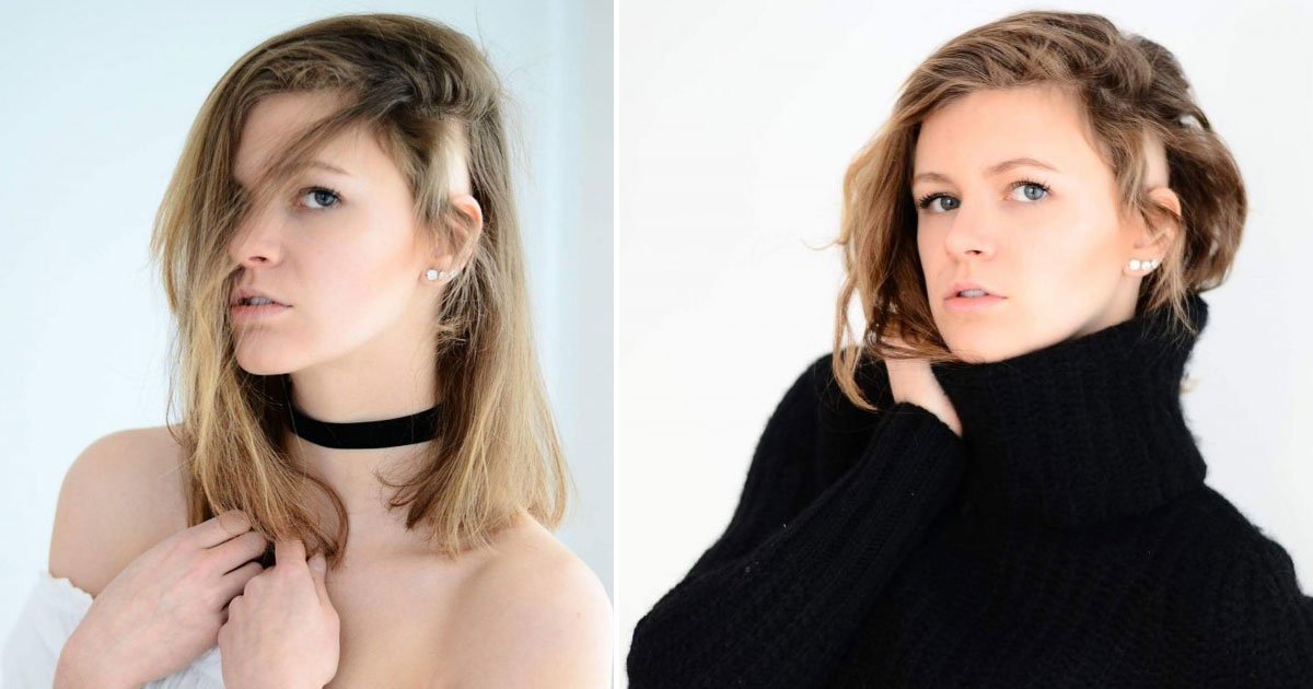 model who hid alopecia for nine years revealed bald spots in modeling shots.jpg?resize=412,275 - Model - Who Hid Alopecia For Nine Years - Revealed Bald Spots In Modeling Shots