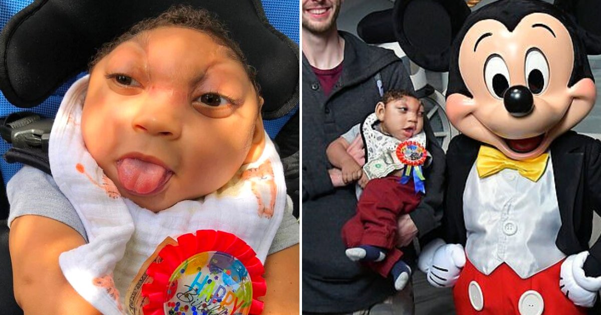 ozzie6.png?resize=412,275 - Baby Born With Part Of His Brain Outside His Misshapen Skull Celebrated His First Birthday