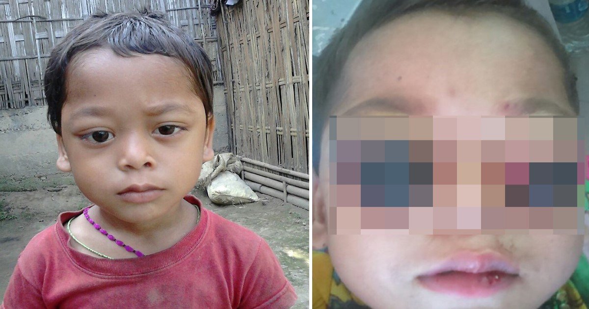 2 48.jpg?resize=1200,630 - A Young Boy Who Lost Both Eyes To Rare Cancer Could Now See Again