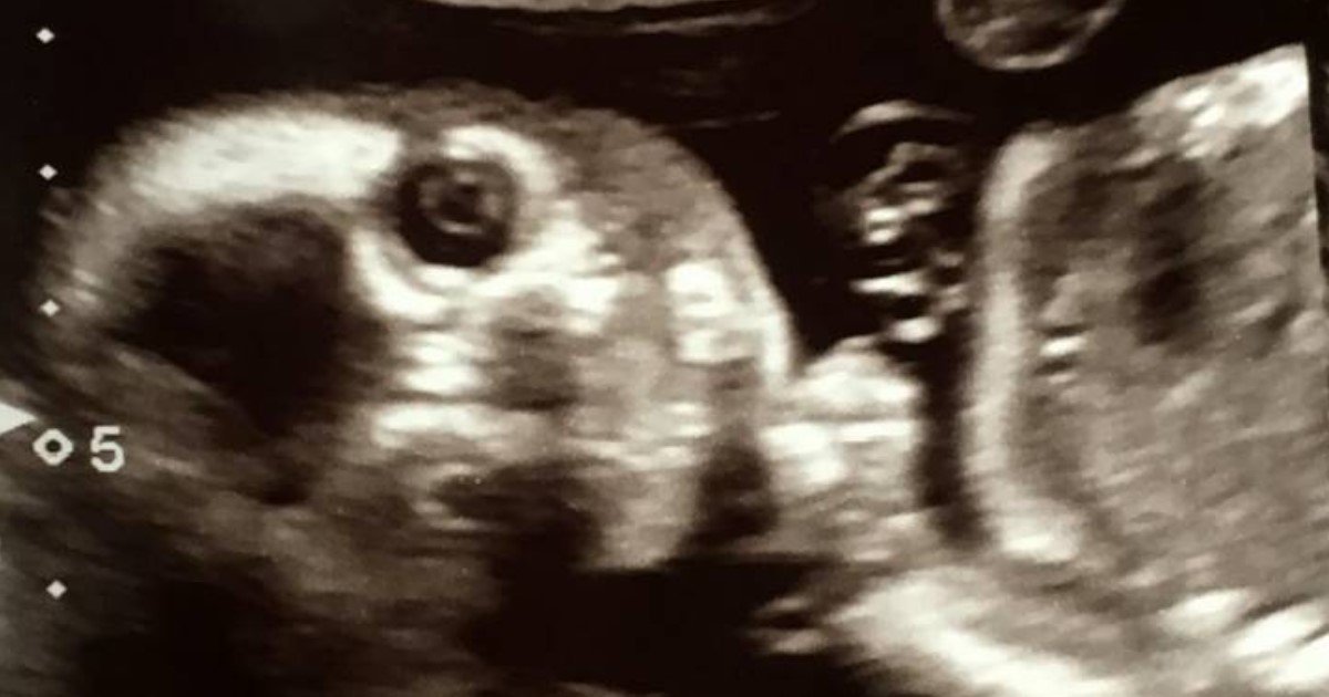 2 94.jpg?resize=1200,630 - A Baby Stared Back At The Camera During A 20-Week Ultrasound Scan
