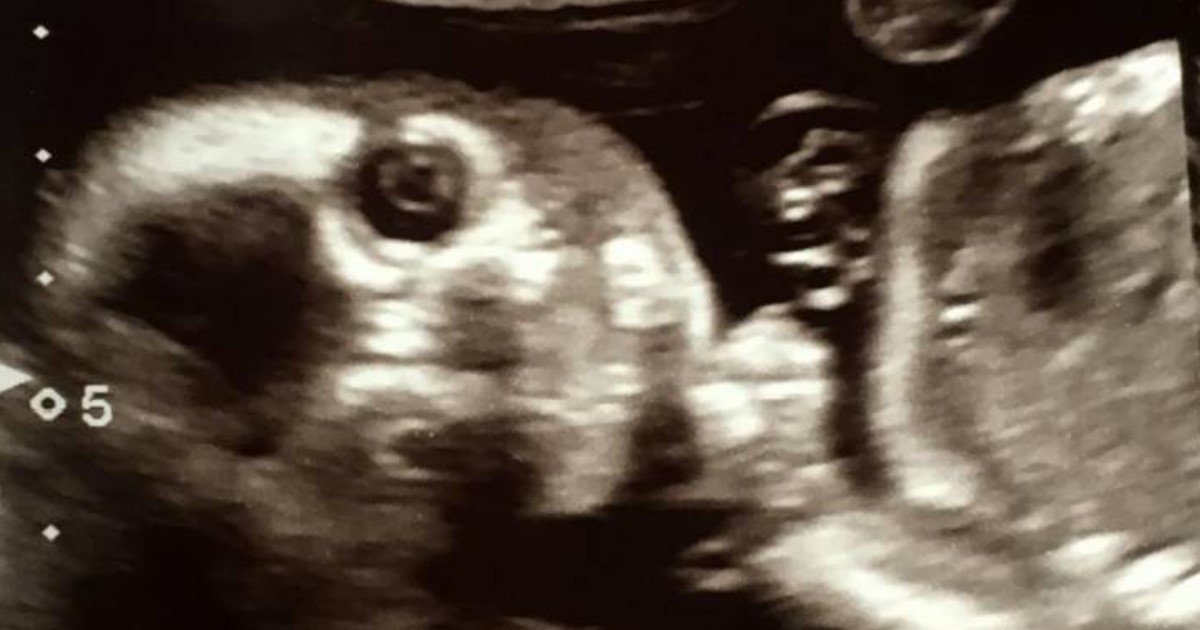 2 94.jpg?resize=412,232 - A Baby Stared Back At The Camera During A 20-Week Ultrasound Scan