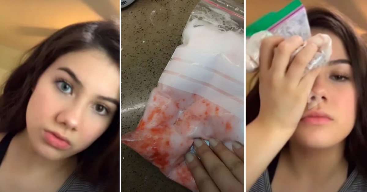 5 47.png?resize=412,275 - Teens Trying Eye Bleaching To Change Their Eye Color