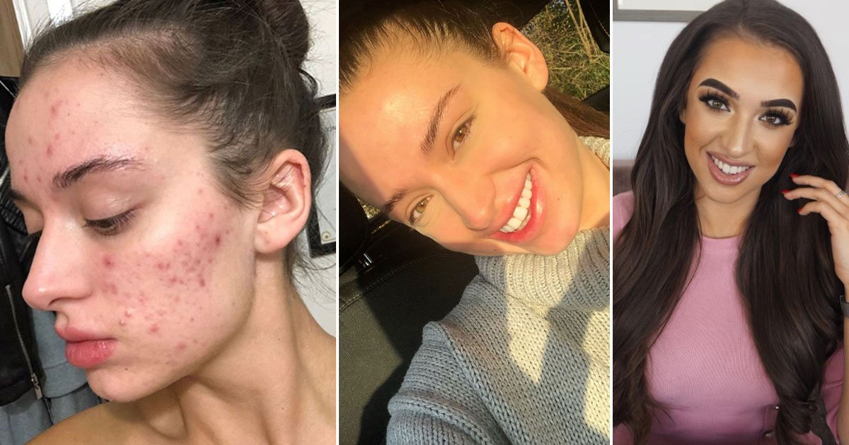 controversial acne drug.jpg?resize=1200,630 - Une femme souffrant d'acné a utilisé une pommade controversée pour nettoyer sa peau