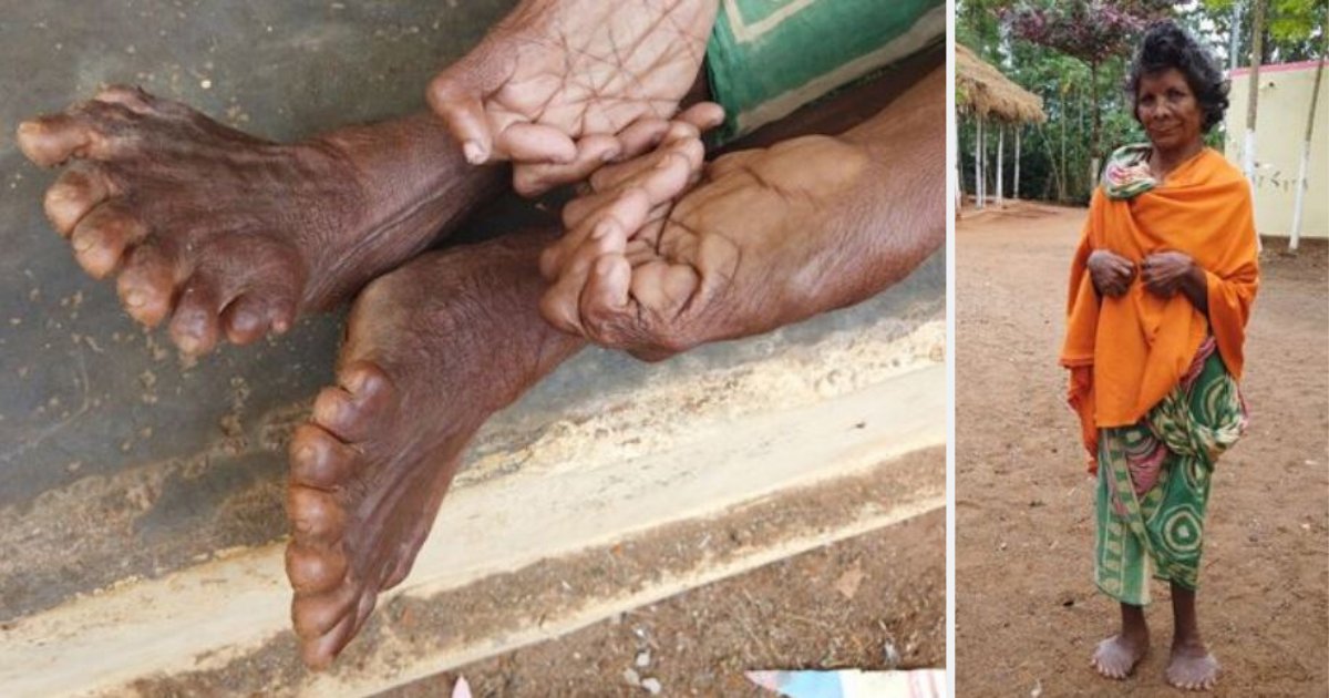 d5.png?resize=412,275 - A Woman Born With 12 Fingers and 19 Toes All Set To Enter World Record But Is Branded as “Witch” By Locals