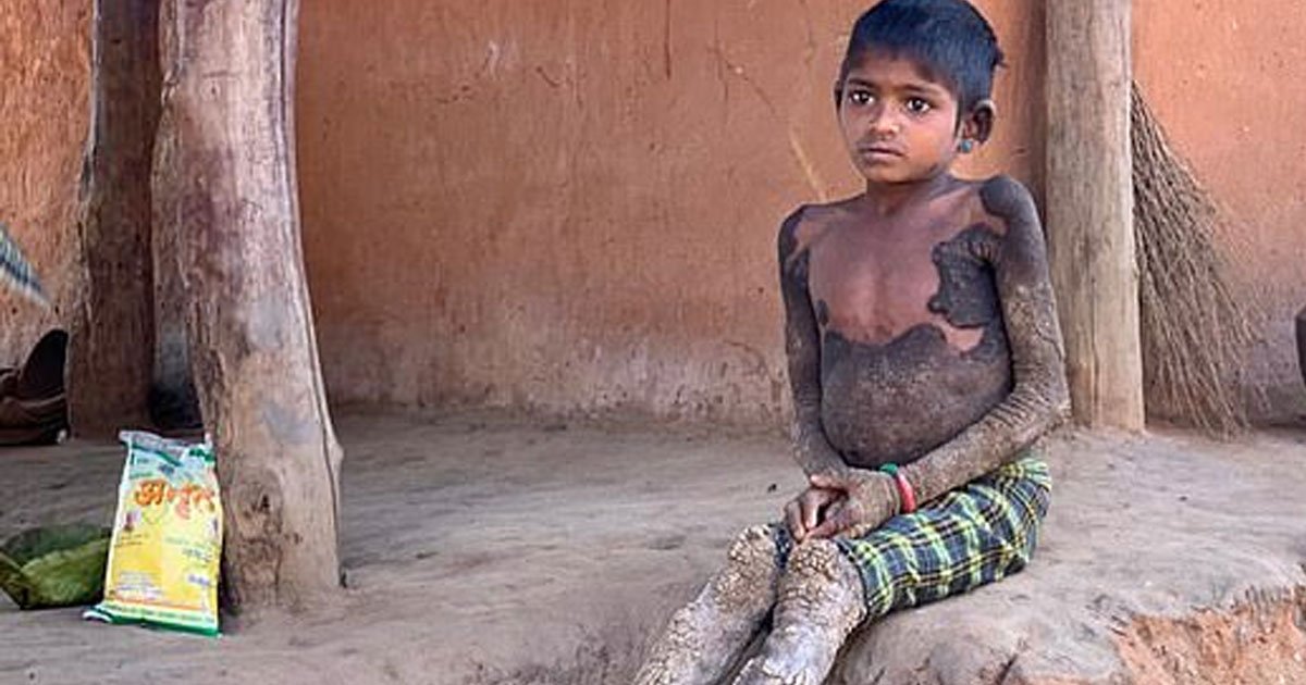 7-year-old-girl-s-rare-condition-turns-her-skin-into-stone-small-joys