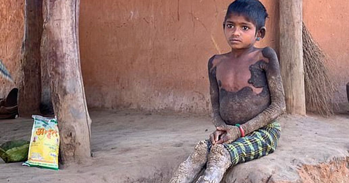 untitled 1 28.jpg?resize=1200,630 - 7-Year-Old Girl's Rare Condition Turns Her Skin Into Stone