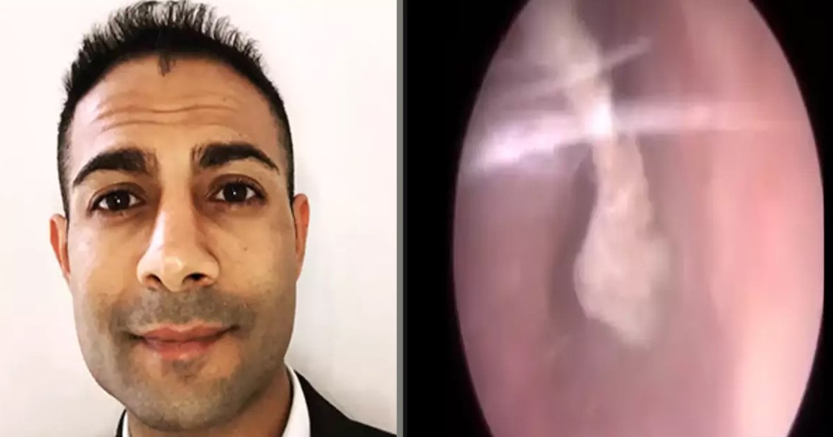 untitled 3 1.jpg?resize=412,275 - A Man Almost Lost His Hearing After Getting A Tip Of A Cotton Bud Stuck In His Ear