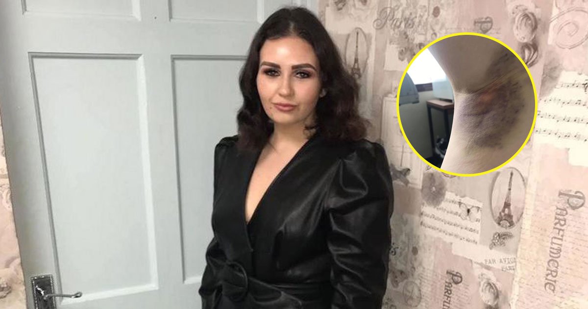 woman died mysterious bruises.jpg?resize=412,275 - 22-Year-Old Mother Passed Away After Mysterious Bruises Appeared On Her Body