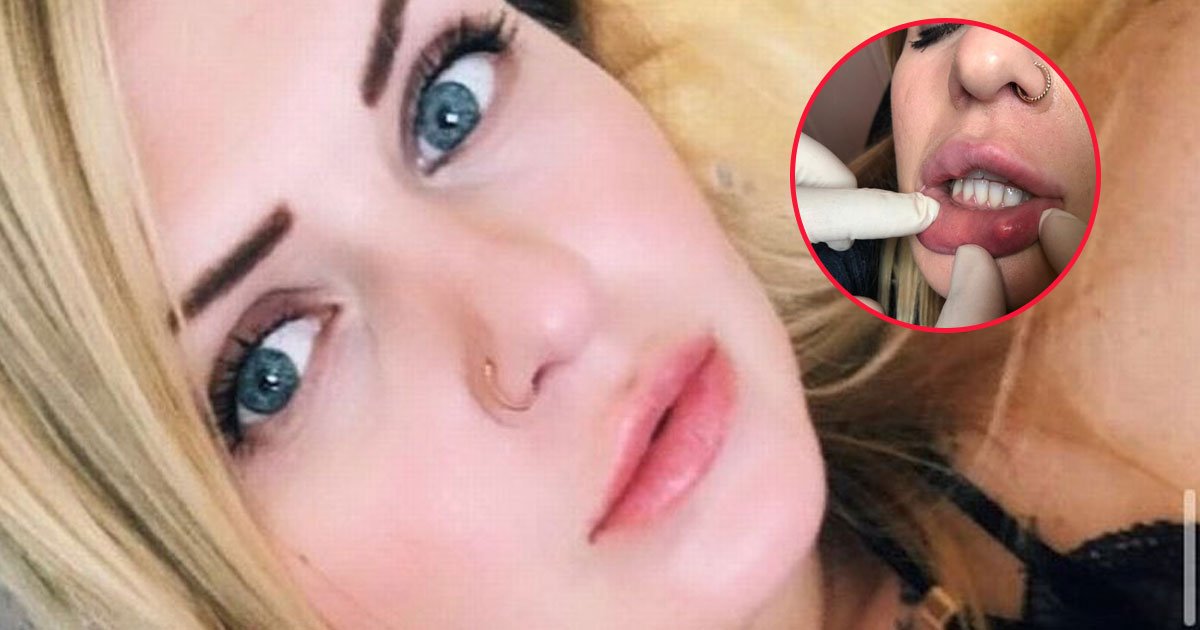 woman warns botched lip procedure.jpg?resize=412,275 - Woman Warns After Her Lips Were Injected With Wrong Chemicals By A Beautician Who Later Blocked Her And Moved To A New House