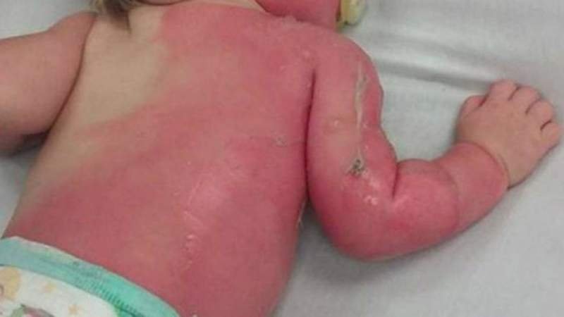 Resultado de imagen de bebe quemada