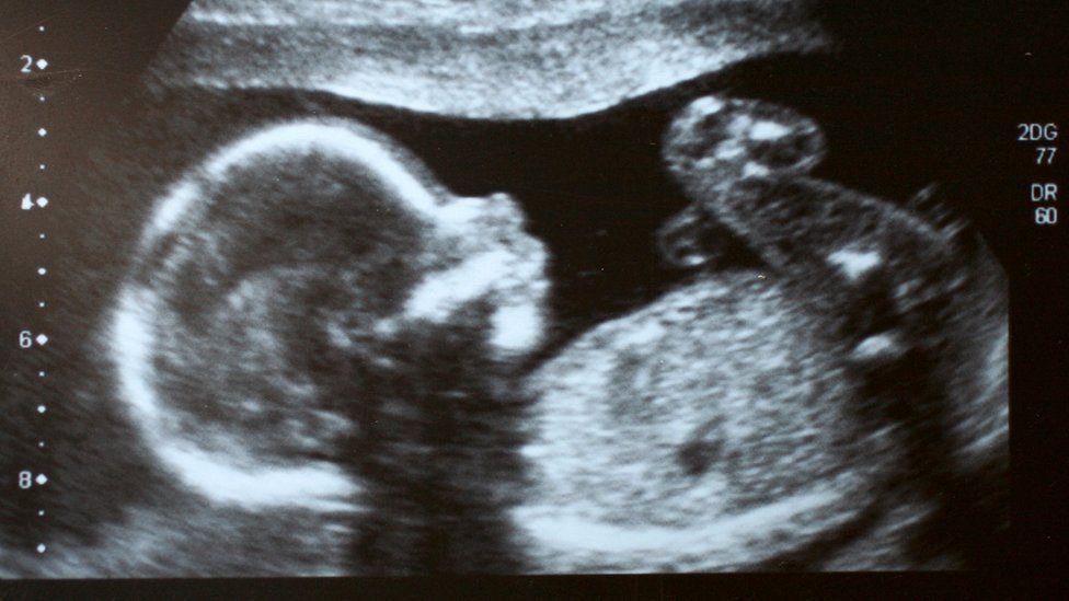 Resultado de imagen de niña corta barriga hermana embarazada brasil