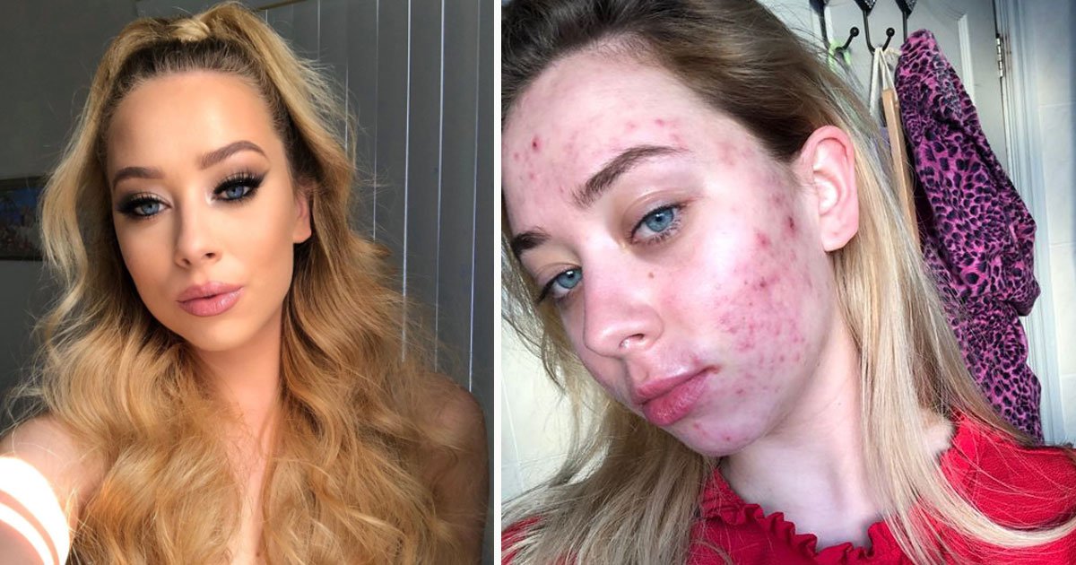 beauty queen acne skin withour makeup pictures.jpg?resize=412,275 - Beauty Queen Shared Make-up Free Pictures To Encourage Others After Hiding Her 'True' Skin From The World For Months