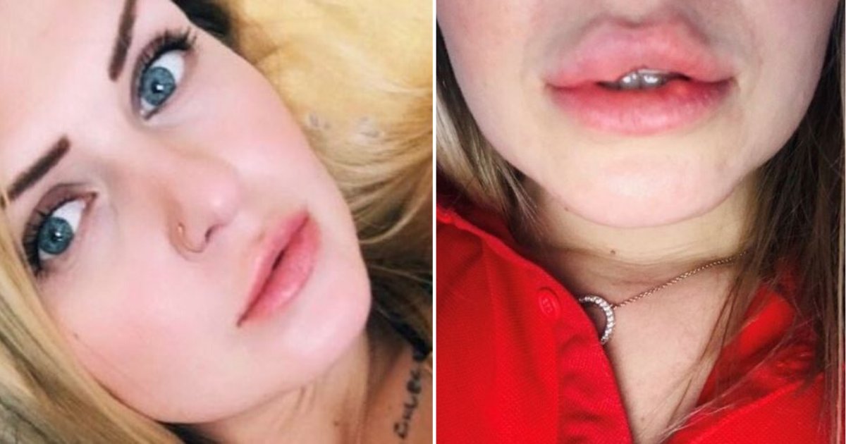 d5 2.png?resize=412,275 - Woman Looks Like She Came Out Of A Horror Show After Lip Filler Goes Wrong