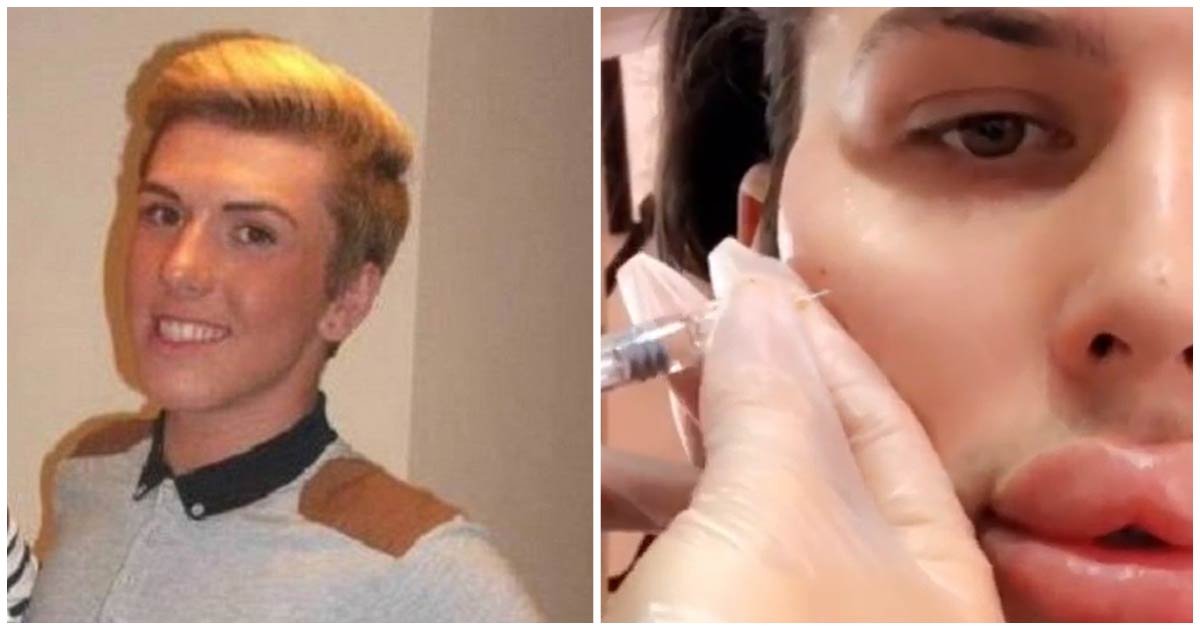header cirugia 1.jpg?resize=412,275 - Joven Obsesionado con la "Belleza" Gasta Miles De Dólares Para Aumentar Sus Labios Hasta El Límite