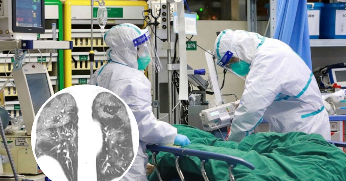 scans3.png?resize=412,275 - X-Ray Images And CT Scans Show What Coronavirus Does To Patients' Lungs