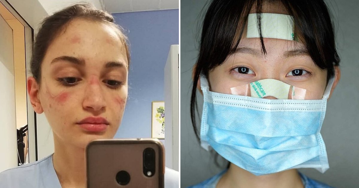 untitled design 1 4.png?resize=412,275 - Coronavirus Nurses Share Photos Of Injuries Caused By Wearing Face Masks
