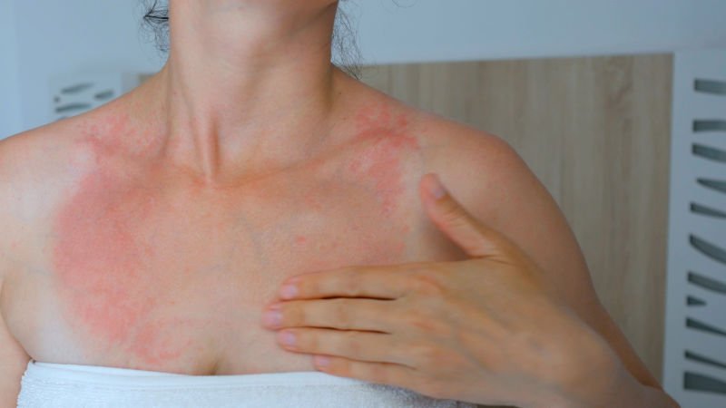 Watch 9 Questions That Will Help You Decode That Rash | SELF Video ...