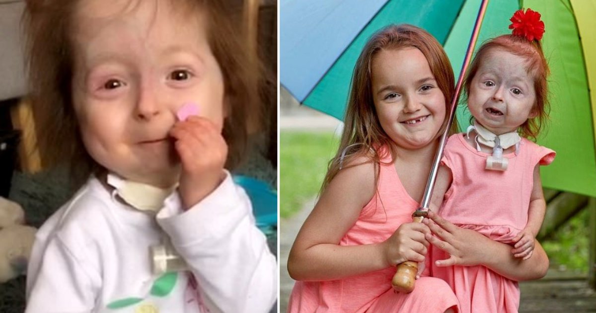 5 15.png?resize=412,232 - Little Girl Who Is The Only Person With Rare Disease Benjamin Button Goes Viral On TikTok