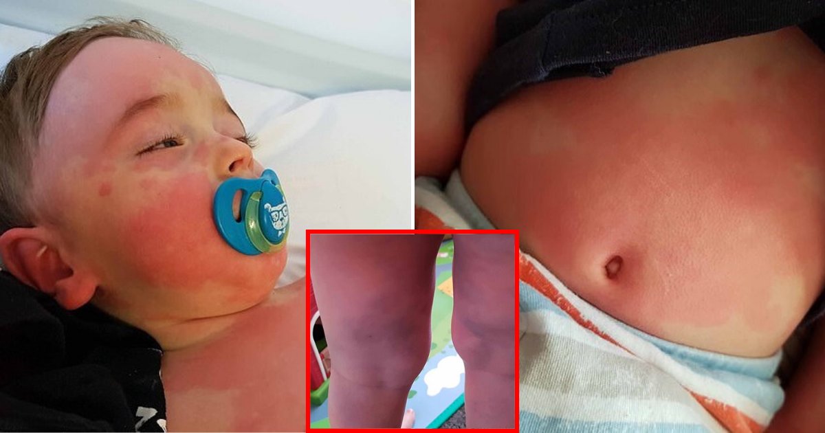 rash6.png?resize=1200,630 - 2-Year-Old Boy Rushed To Hospital With 'Inflammatory Syndrome' Thought To Be Linked To Coronavirus