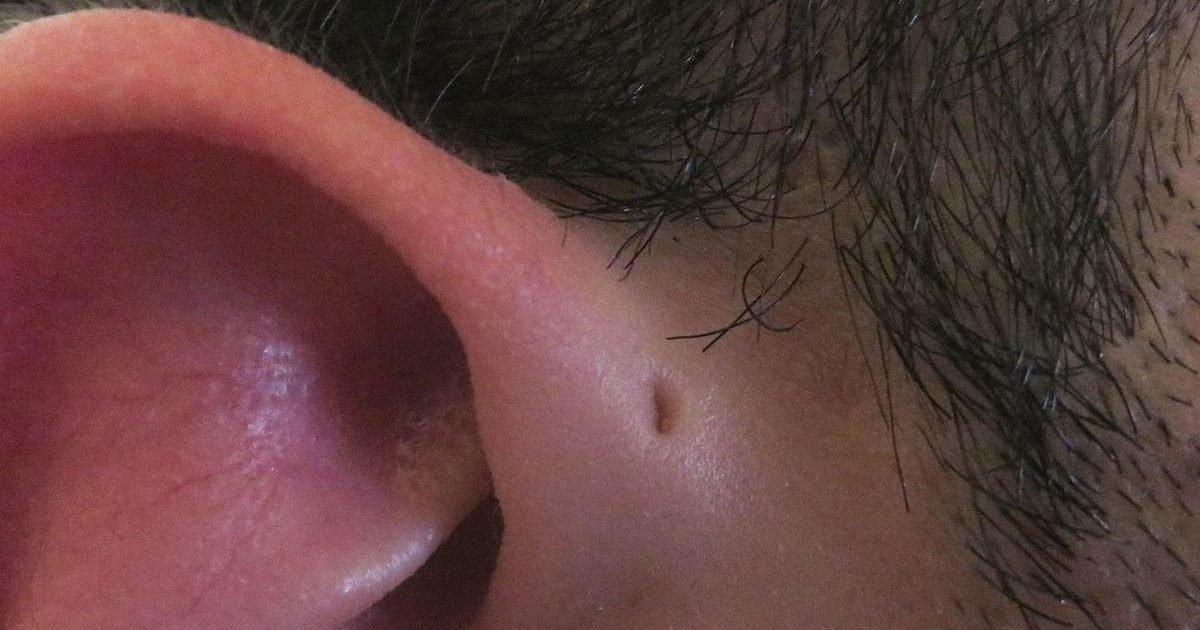 sinus preauriculaire e1587405231226.jpg?resize=1200,630 - Pourquoi certaines personnes ont un petit trou près de l'oreille? La réponse!