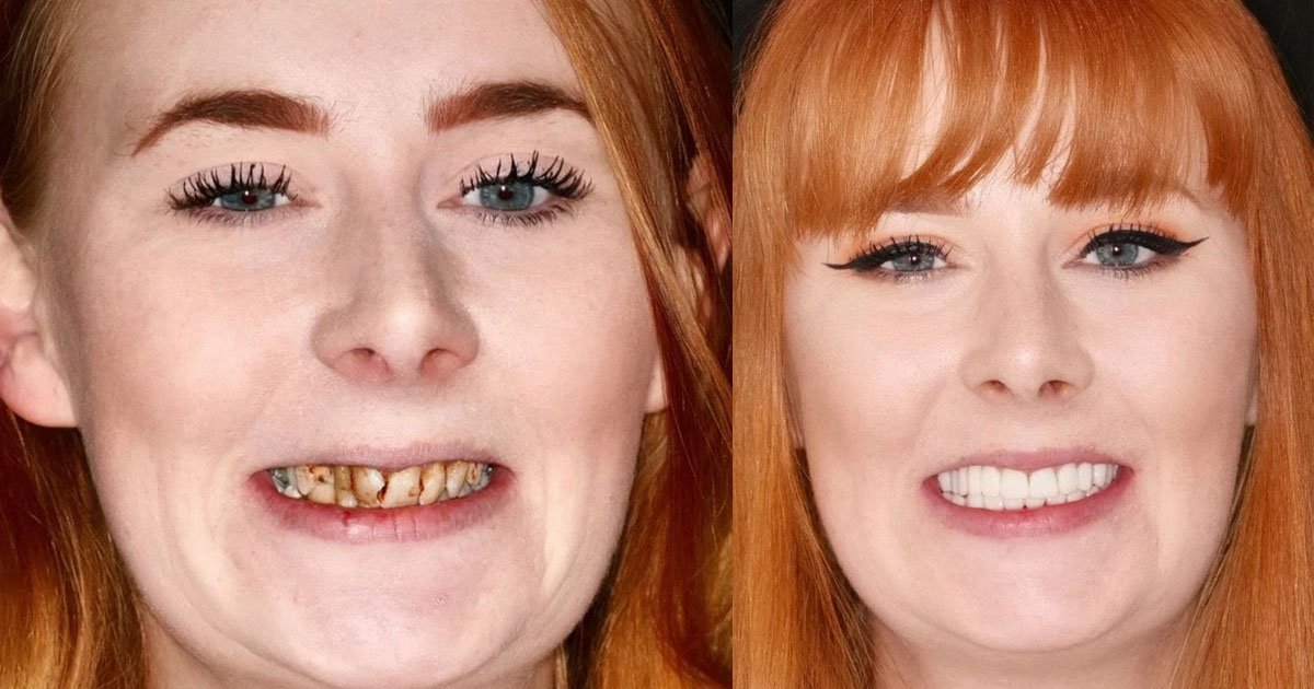 woman who was warned she would need full dentures to fix her rotten teeth transformed them with braces.jpg?resize=412,275 - A Woman Who Was Recommended To Wear Dentures Due To Rotten Teeth Got An Amazing Transformation Instead