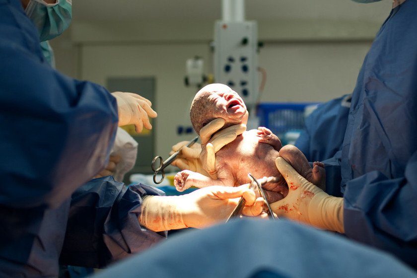 Uno de cada cinco bebés nacen por cesárea en el mundo, casi el doble de lo recomendado por la OMS