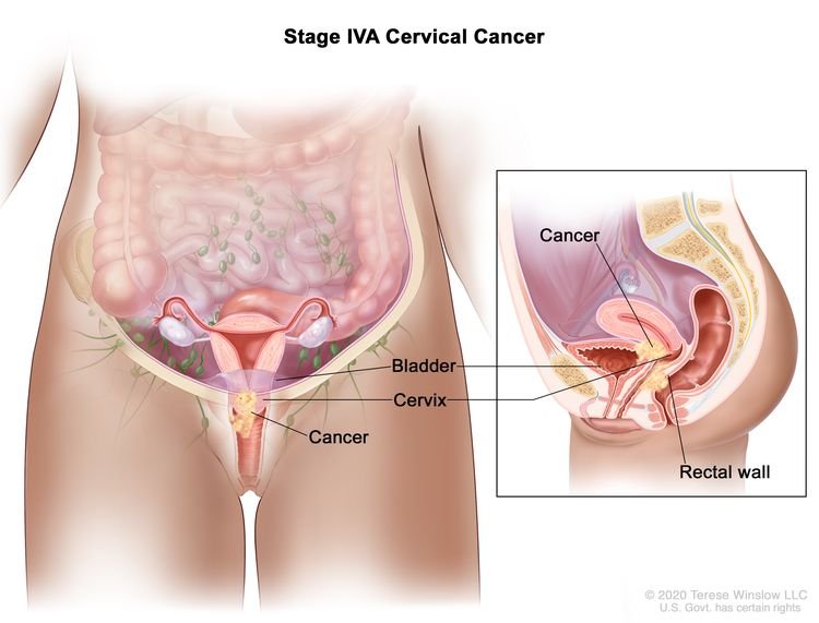 Cervical cancer symptoms 