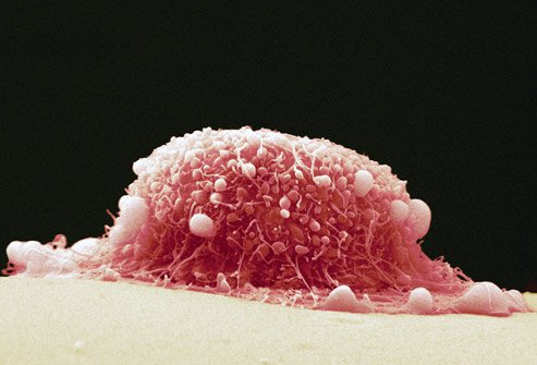 cervical cancer symptoms in microscopic view