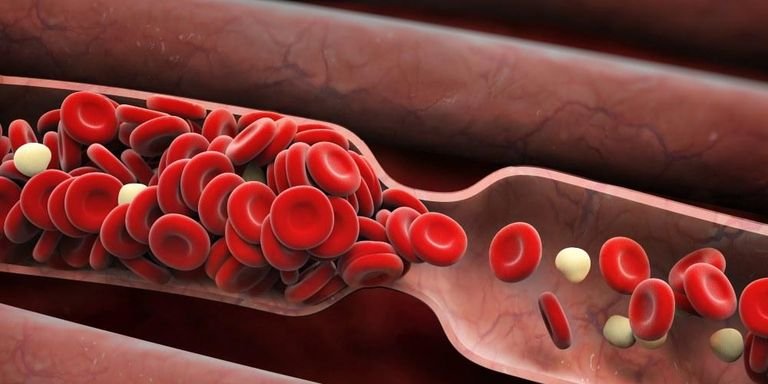 Blood clot signs in vessels