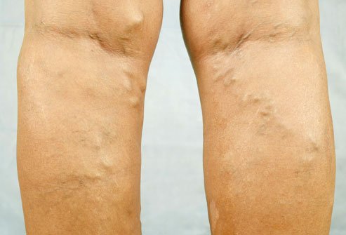 Varicose Veins are blood clot signs