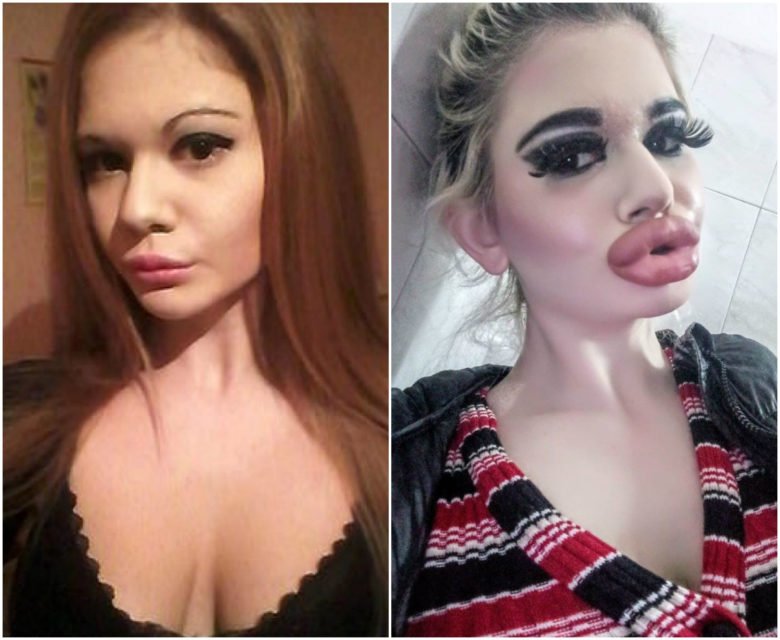 Before and after 17 injections for biggest lips in the world