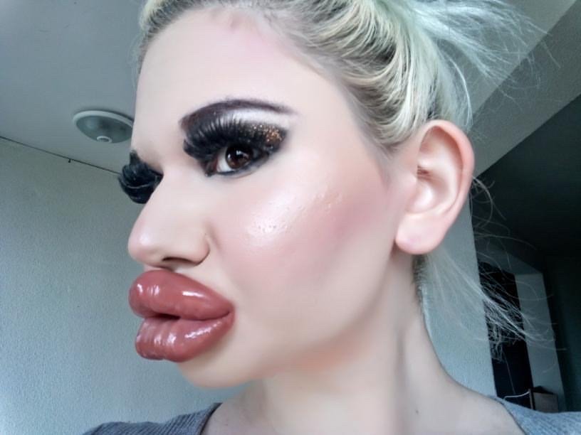 Woman aspires for biggest lips in the world.