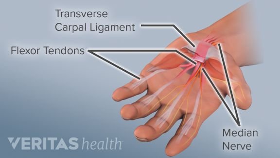 what is carpel tunnel syndrome
