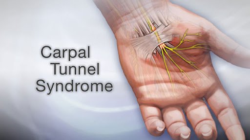 carpal tunnel syndrome cure