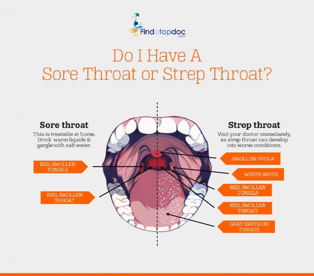 some strep throat symptoms