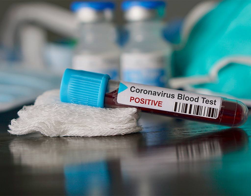 Monos roban muestras de sangre con coronavirus SARS-CoV-2 en India ...