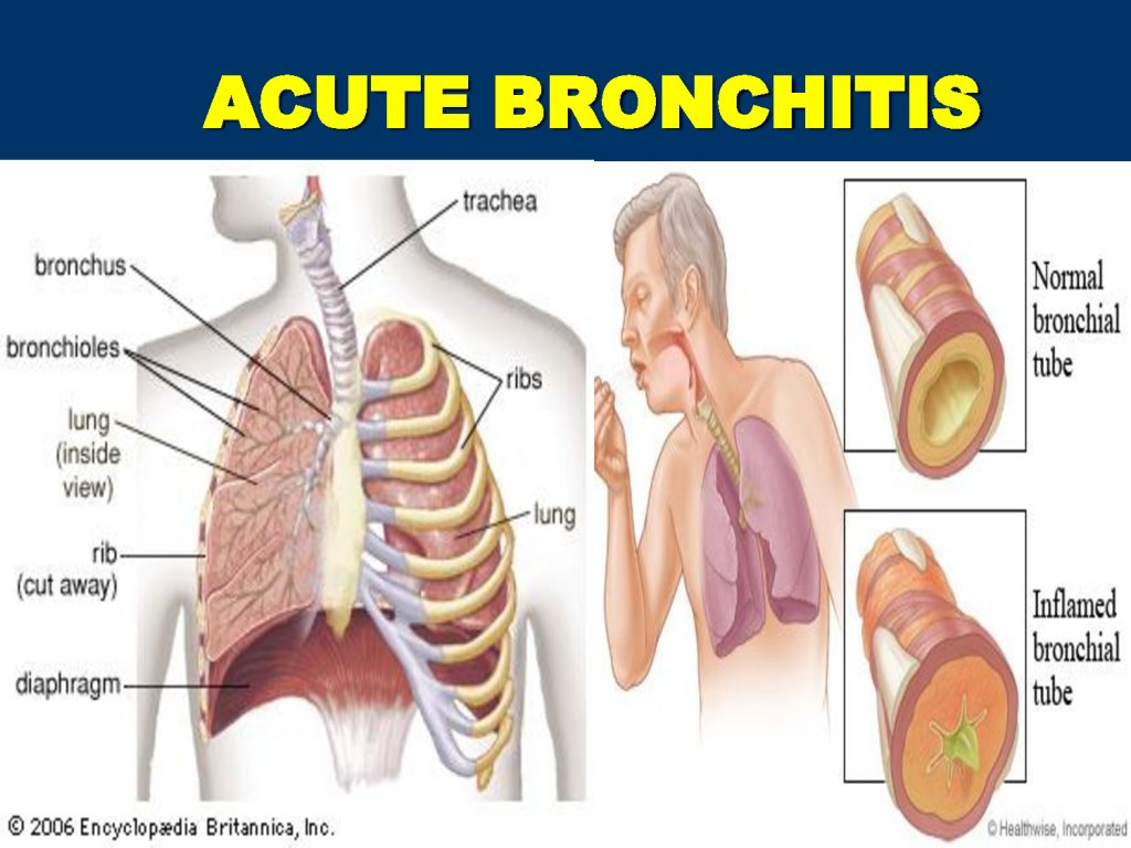 is bronchitis contagious? symptoms and preventions