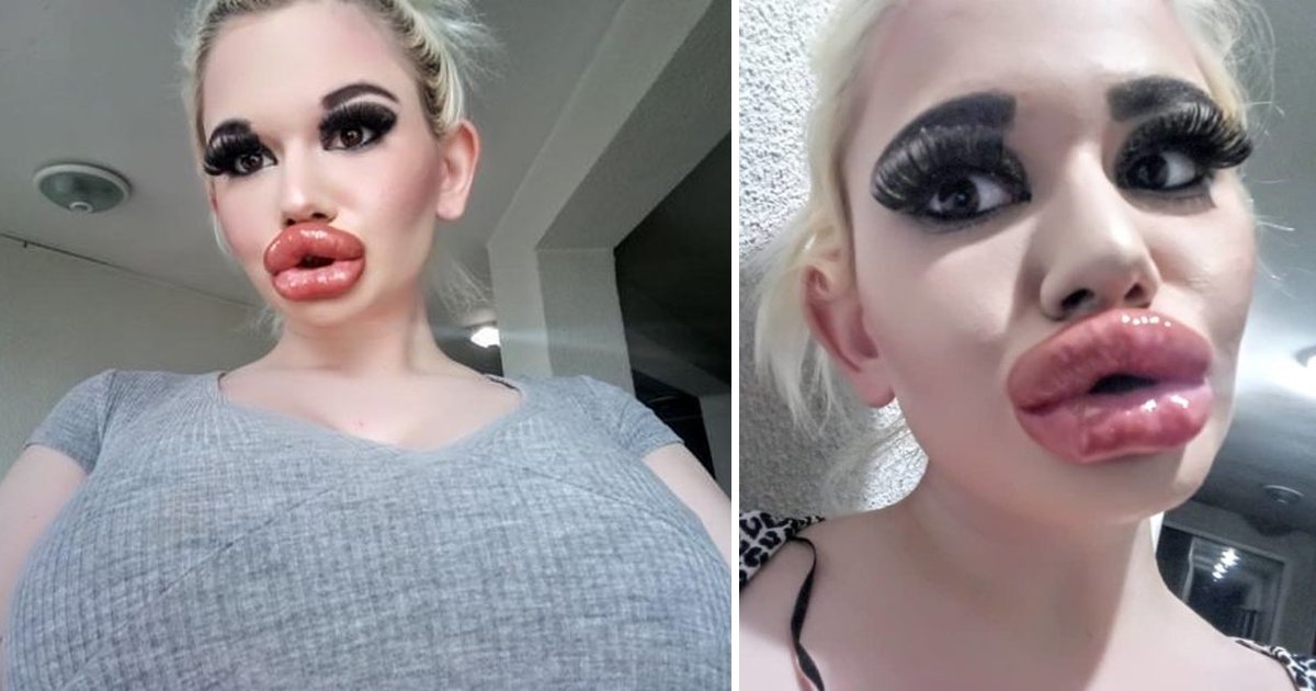 biggest lips world.jpg?fit=1024%2C538&ssl=1&strip=all - Woman Receives 17 Injections To Have Biggest Lips In The World