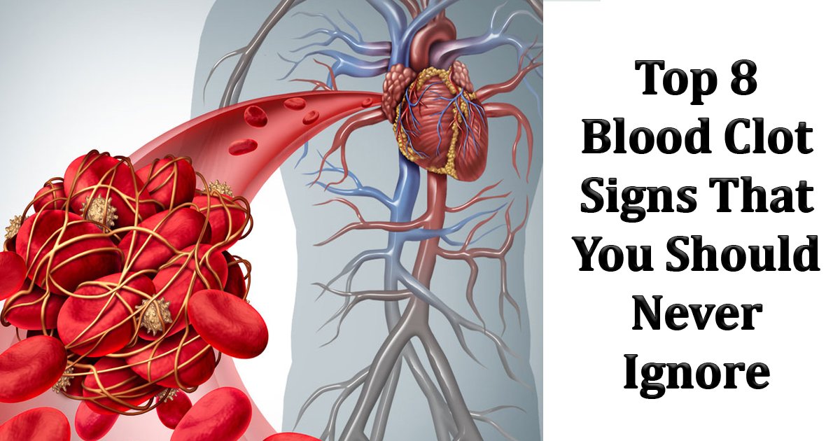 Top 8 Blood Clot Signs That Trigger Warning