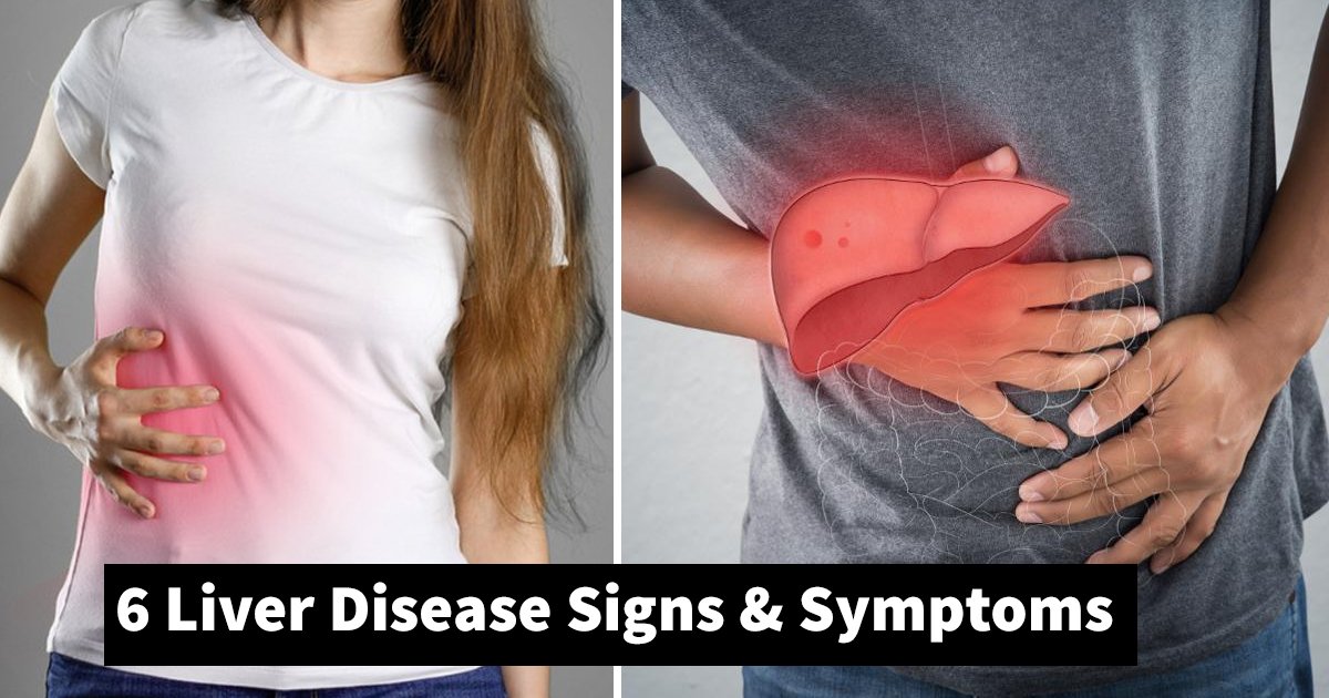liver disease.jpg?resize=412,275 - 6 Liver Disease Symptoms Showing Your Health Crisis
