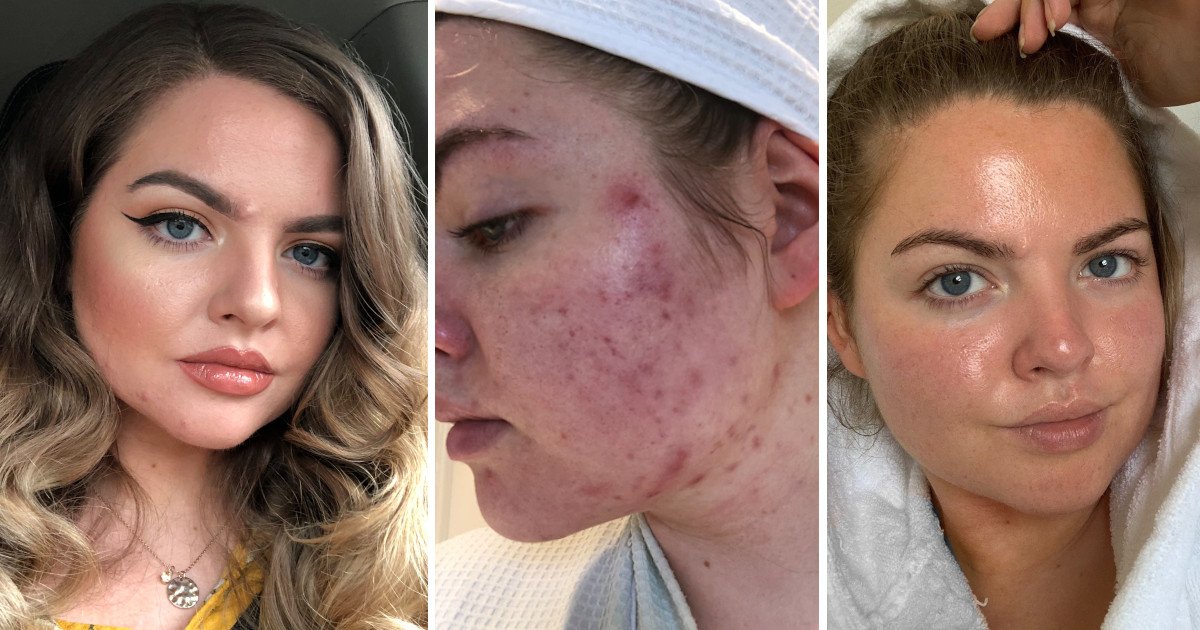 untitled 7.jpg?resize=412,275 - Woman With Severe Acne Tried A £17.99 Tanning Water That Cleared Up Her Skin Within A Week